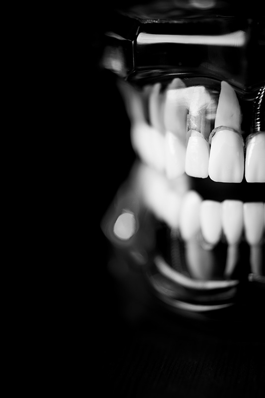Implantes dentales en Zaragoza Implantes dentales en Zaragoza