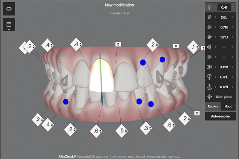 Invisalign en Zaragoza Invisalign en Zaragoza