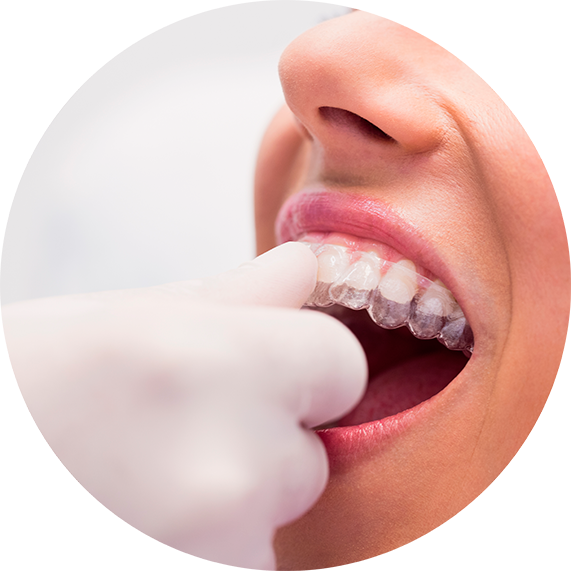 Invisalign en Zaragoza Invisalign en Zaragoza