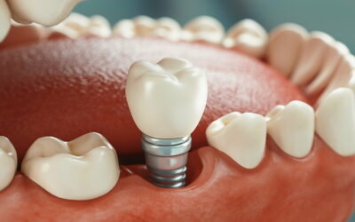 Implantes dentales: proceso paso a paso y cuidados posteriores