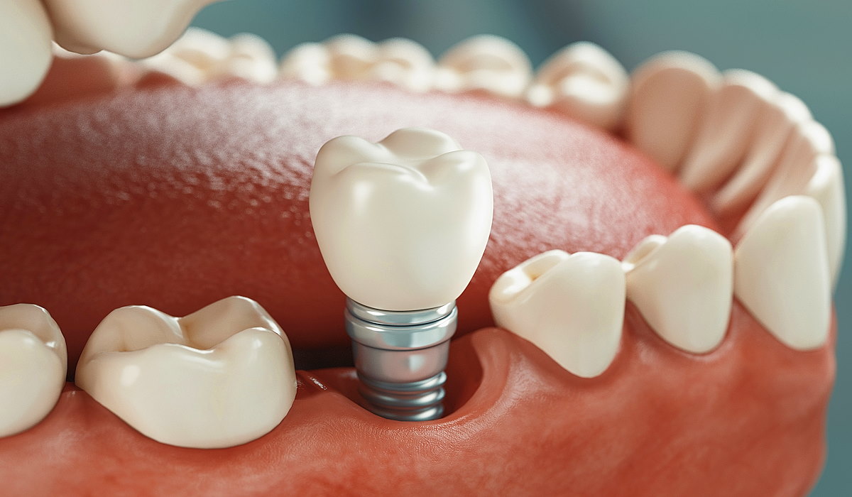Implantes dentales: proceso paso a paso y cuidados posteriores