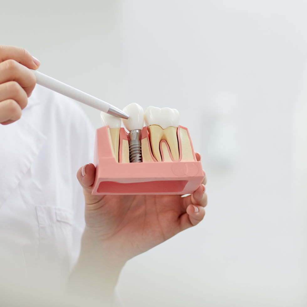 ¿Qué es un implante dental?